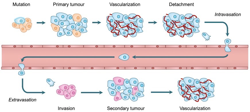 metastasis